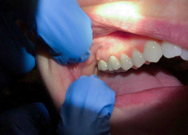 Best Emergency Dental Care for Broken or Chipped Teeth in Monmouth Beach, NJ